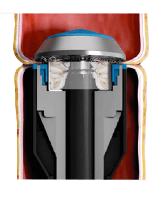 Traditional circular staplers with limited housing