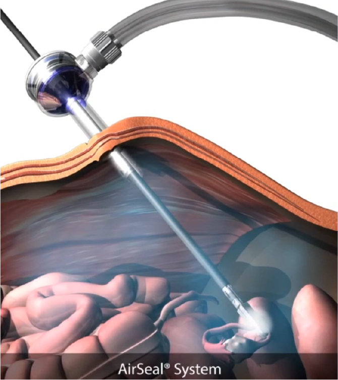 low impact laparoscopy insufflation